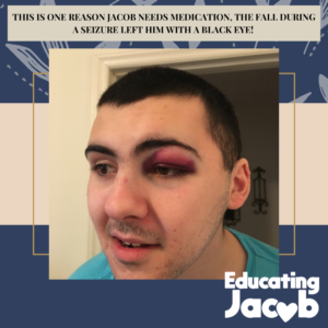 Black eye as a result of fall from seizure